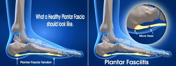 Plantarna fascija: od očajanja do izlečenja fotografija fascija graf Plantarna fascija: od očajanja do izlečenja